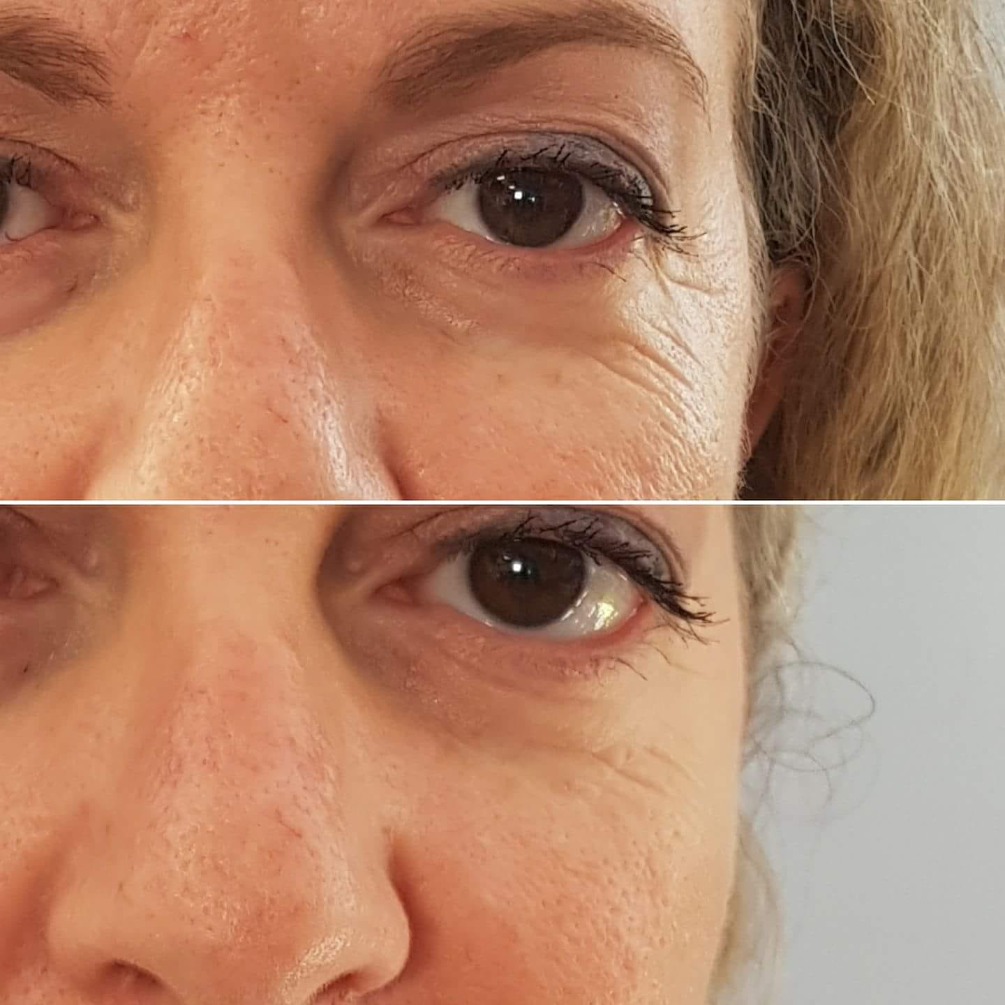 Wrinkle-reducing effect