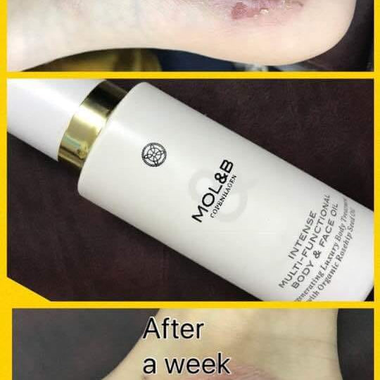 Visible improvement in psoriasis-prone skin