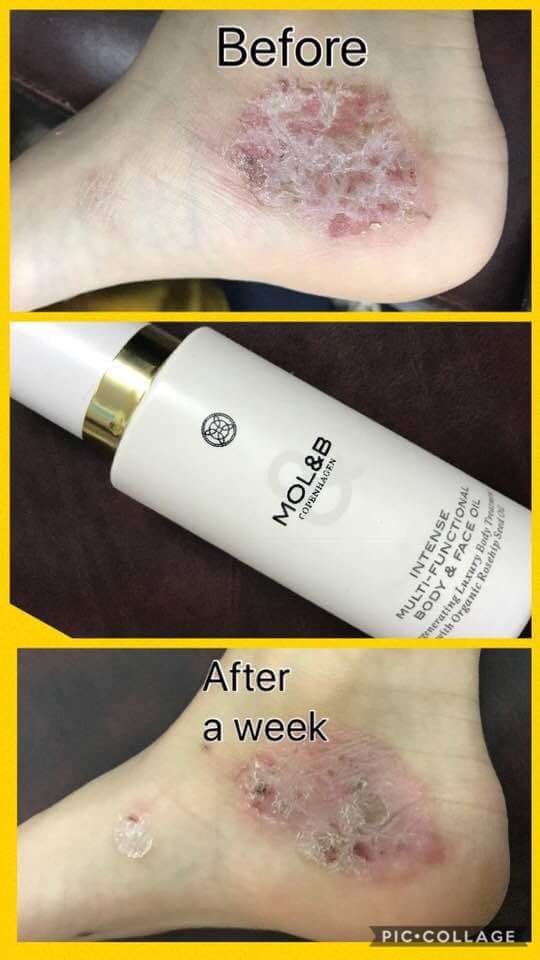 Visible improvement in psoriasis-prone skin