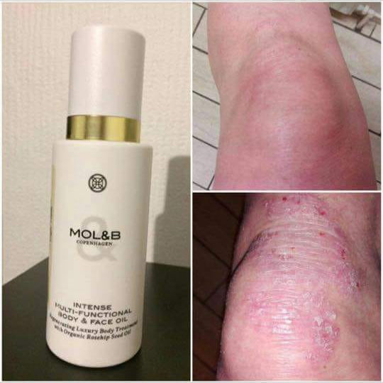 Visible improvement in psoriasis-prone skin