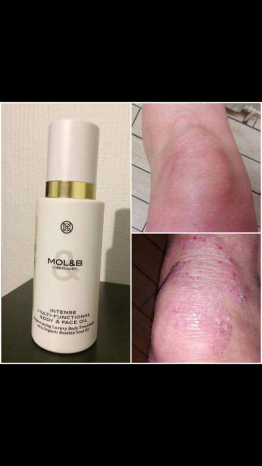 Visible improvement in psoriasis-prone skin