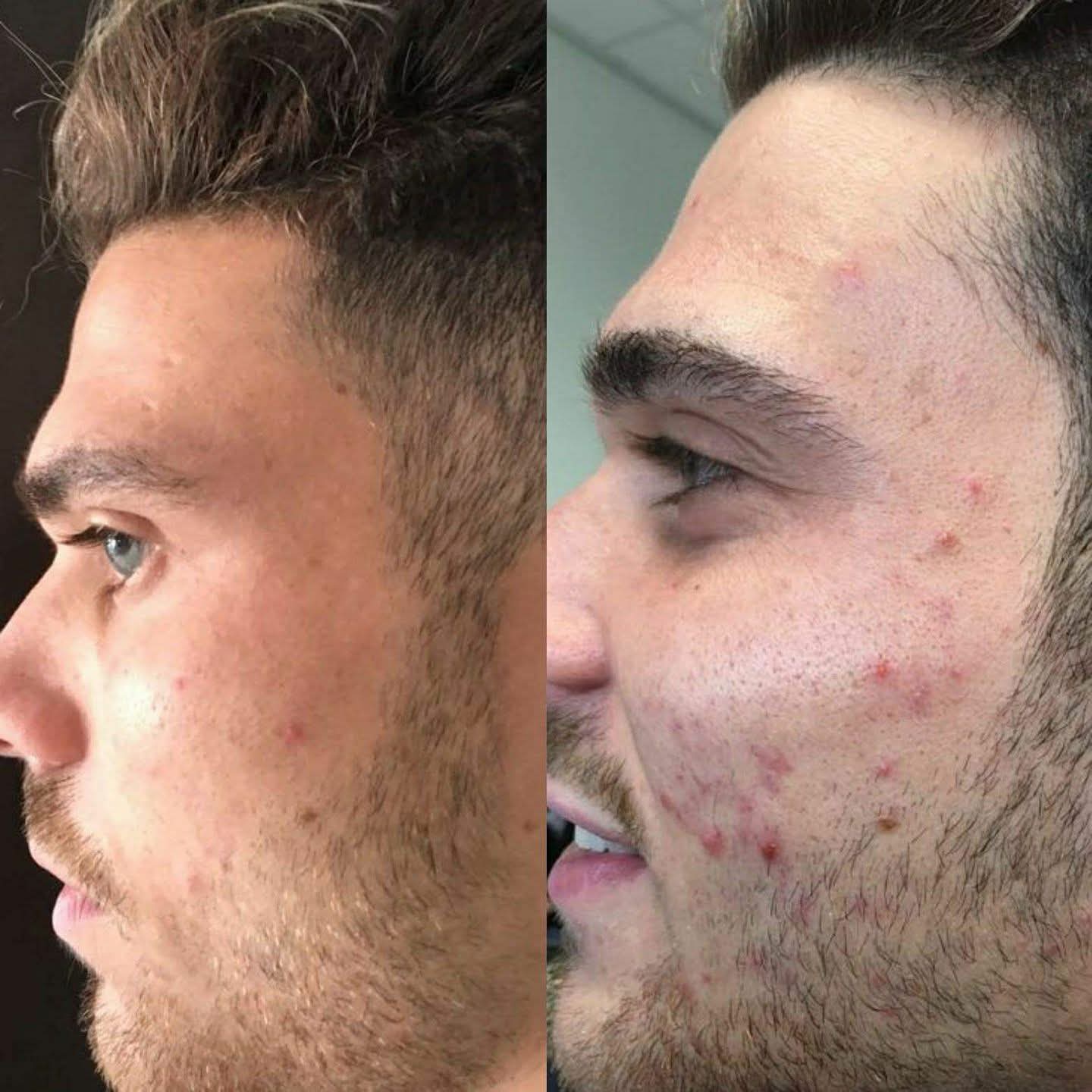 Effects on acne-prone skin